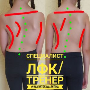 ЛФК при врожденном сколиозе 3 степени