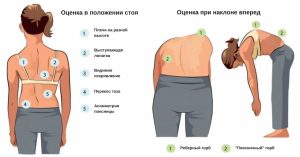 Методы диагностики сколиоза