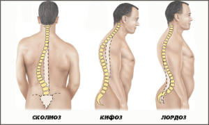 Лордох, кифоз и сколиоз - отличия