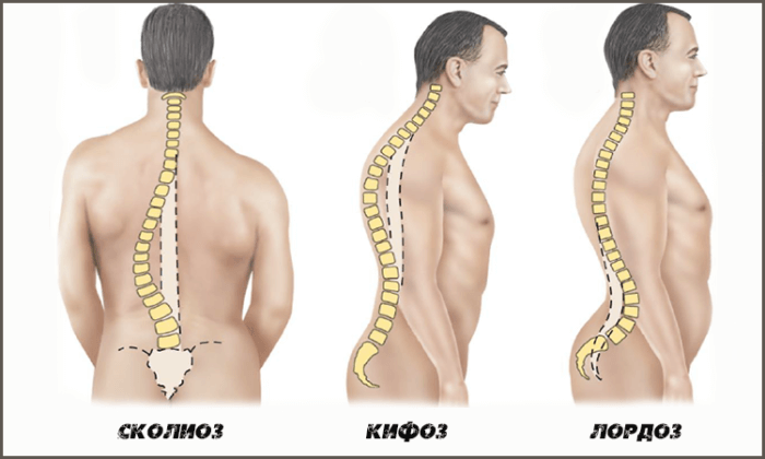 Лордох, кифоз и сколиоз - отличия