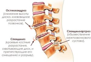 процесс дегенерации межпозвоночных дисков